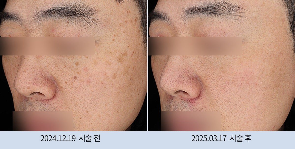 스노우의원 다산점 색소 시술 전후